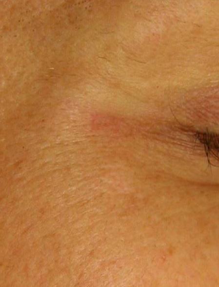 Nach der Laser-Tattoo-Entfernung