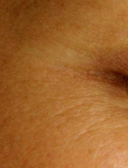 Vor der Laser-Tattoo-Entfernung