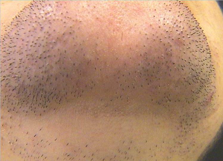 Vor der Laser-Haarentfernung