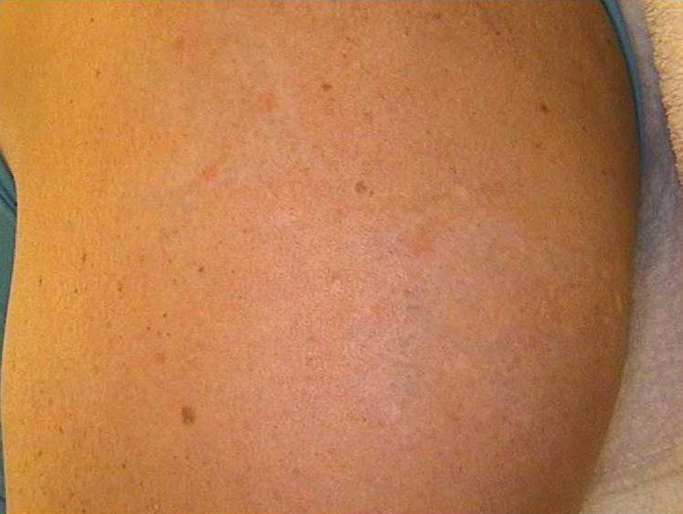 Nach der Laser-Tattoo-Entfernung