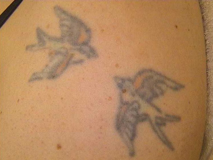 Vor der Laser-Tattoo-Entfernung